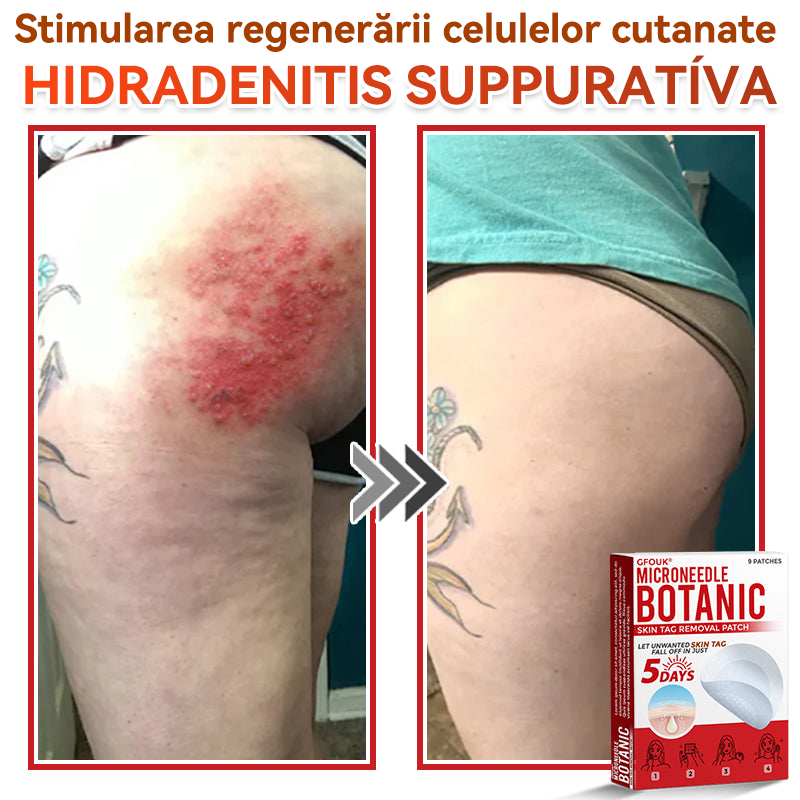 🗽✅ GFOUK® Plasture botanic cu microace pentru îndepărtarea verucilor și a negilor