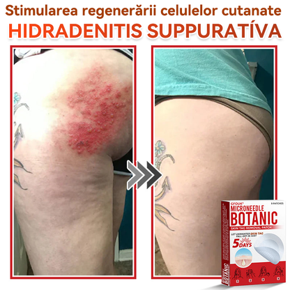 🗽✅ GFOUK® Plasture botanic cu microace pentru îndepărtarea verucilor și a negilor