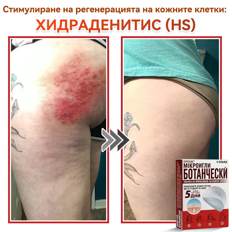 🎁 Остават само 5 опаковки! Сега можете да получите допълнителна ОТСТЪПКА от 50%!🗽✅ GFOUK® Ботаничен пластир с микроигли за премахване на кожни образувания