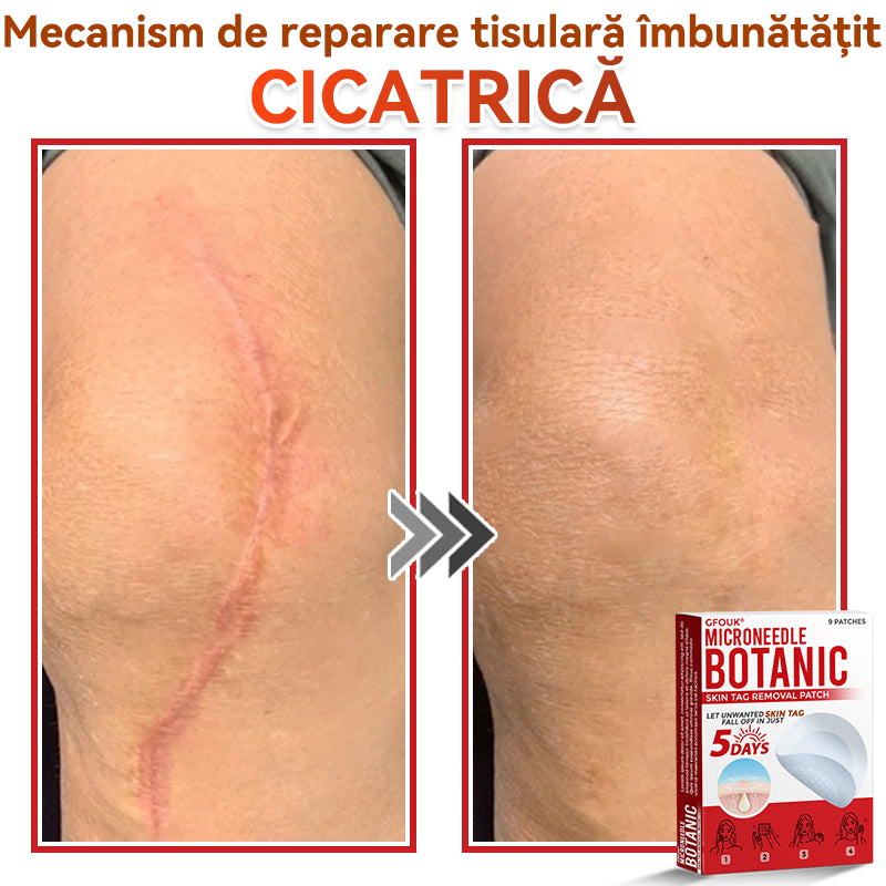 🗽✅ GFOUK® Plasture botanic cu microace pentru îndepărtarea verucilor și a negilor