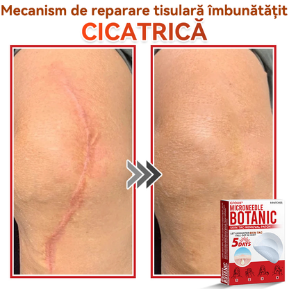 🗽✅ GFOUK® Plasture botanic cu microace pentru îndepărtarea verucilor și a negilor