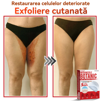 🗽✅ GFOUK® Plasture botanic cu microace pentru îndepărtarea verucilor și a negilor