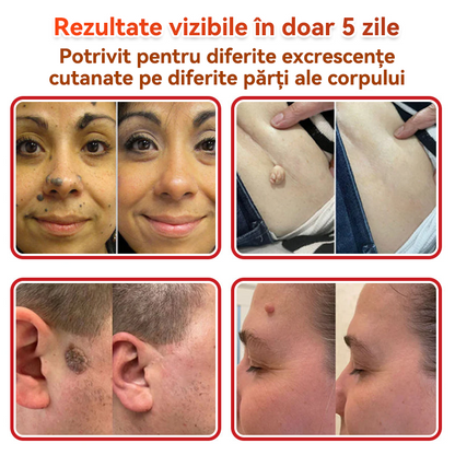 🗽✅ GFOUK® Plasture botanic cu microace pentru îndepărtarea verucilor și a negilor