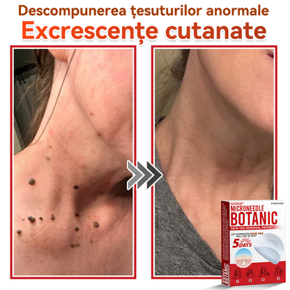 🗽✅ GFOUK® Plasture botanic cu microace pentru îndepărtarea verucilor și a negilor