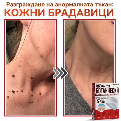 🔥🔥GFOUK® Ботаничен пластир с микроигли за премахване на кожни образувания