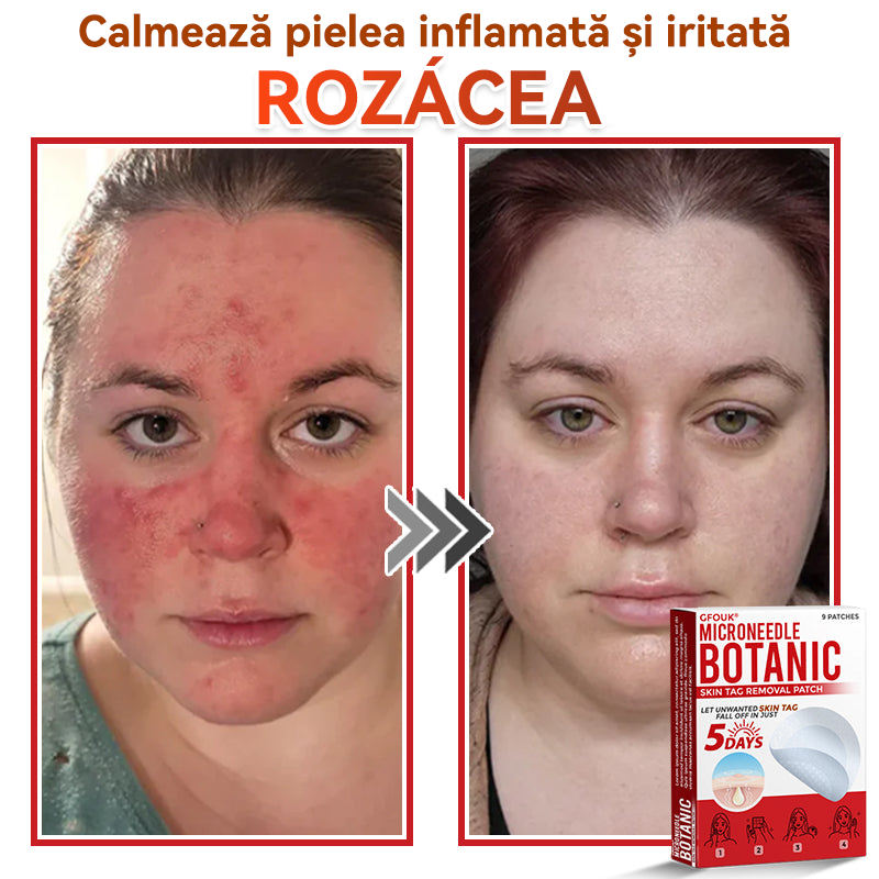 🗽✅ GFOUK® Plasture botanic cu microace pentru îndepărtarea verucilor și a negilor