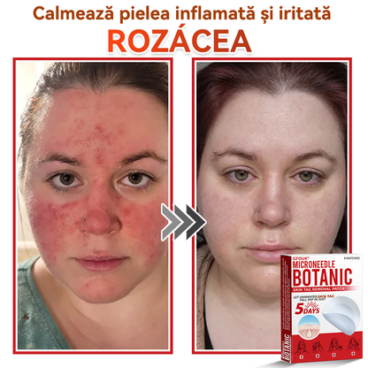🗽✅ GFOUK® Plasture botanic cu microace pentru îndepărtarea verucilor și a negilor