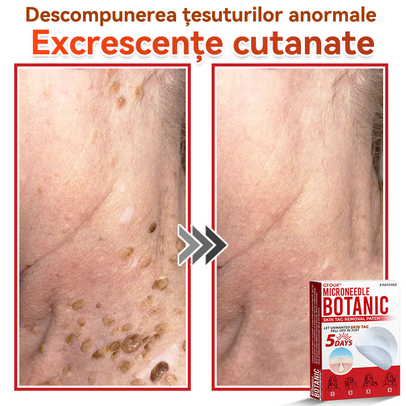 🗽✅ GFOUK® Plasture botanic cu microace pentru îndepărtarea verucilor și a negilor